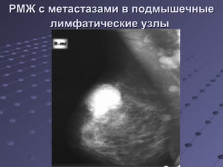 РМЖ с ммееттаассттааззааммии вв ппооддммыышшееччнныыее 
ллииммффааттииччеессккииее ууззллыы 
 