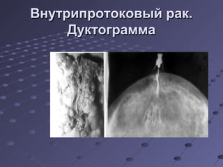 ВВннууттррииппррооттооккооввыыйй рраакк.. 
ДДууккттооггррааммммаа 
 