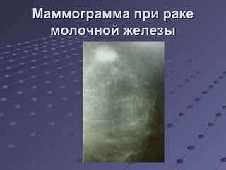 ММааммммооггррааммммаа ппррии ррааккее 
ммооллооччнноойй жжееллееззыы 
 