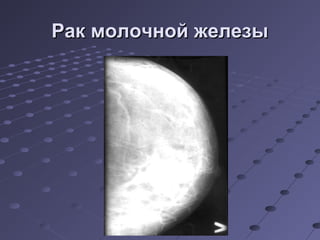 РРаакк ммооллооччнноойй жжееллееззыы 
 