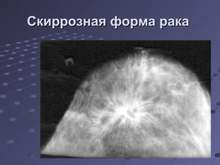 ССккииррррооззннааяя ффооррммаа ррааккаа 
 