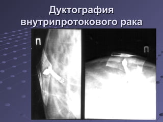 ДДууккттооггррааффиияя 
ввннууттррииппррооттооккооввооггоо ррааккаа 
 