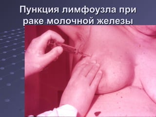 ППууннккцциияя ллииммффооууззллаа ппррии 
ррааккее ммооллооччнноойй жжееллееззыы 
 