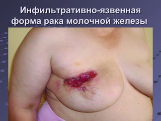 ИИннффииллььттррааттииввнноо--яяззввееннннааяя 
ффооррммаа ррааккаа ммооллооччнноойй жжееллееззыы 
 