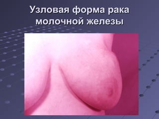 УУззллооввааяя ффооррммаа ррааккаа 
ммооллооччнноойй жжееллееззыы 
 