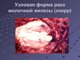 УУззллооввааяя ффооррммаа ррааккаа 
ммооллооччнноойй жжееллееззыы ((ссккиирррр)) 
 