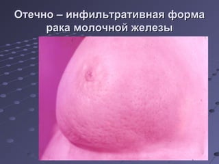 ООттееччнноо –– ииннффииллььттррааттииввннааяя ффооррммаа 
ррааккаа ммооллооччнноойй жжееллееззыы 
 