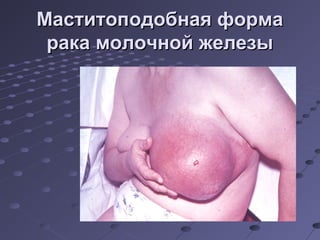 ММаассттииттооппооддооббннааяя ффооррммаа 
ррааккаа ммооллооччнноойй жжееллееззыы 
 