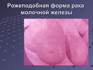 РРоожжееппооддооббннааяя ффооррммаа ррааккаа 
ммооллооччнноойй жжееллееззыы 
 