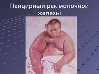 ППааннццииррнныыйй рраакк ммооллооччнноойй 
жжееллееззыы 
 