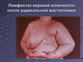 ЛЛииммффооссттаазз ввееррххннеейй ккооннееччннооссттии 
ппооссллее ррааддииккааллььнноойй ммаассттээккттооммииии 
 