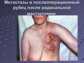 Метастазы вв ппооссллееооппееррааццииоонннныыйй 
ррууббеецц ппооссллее ррааддииккааллььнноойй 
ммаассттээккттооммииии 
 