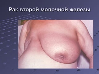 РРаакк ввттоорроойй ммооллооччнноойй жжееллееззыы 
 