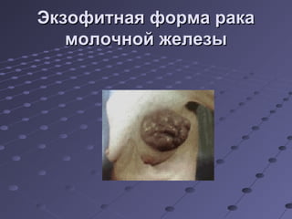 ЭЭккззооффииттннааяя ффооррммаа ррааккаа 
ммооллооччнноойй жжееллееззыы 
 