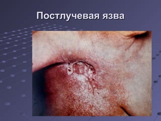 ППооссттллууччееввааяя яяззвваа 
 