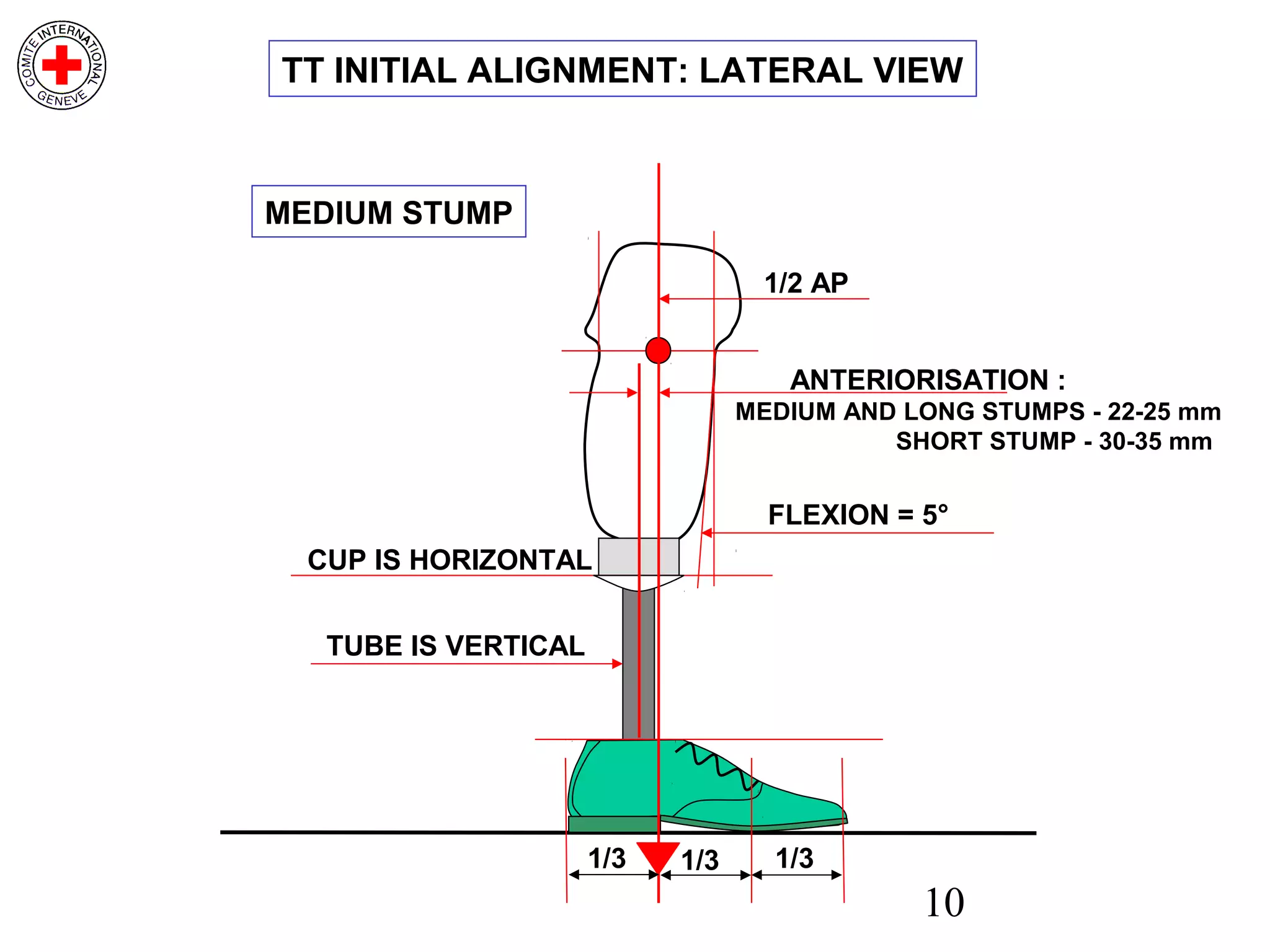 10
TUBE IS VERTICAL
1/2 AP
FLEXION = 5°
CUP IS HORIZONTAL
1/31/31/3
MEDIUM STUMP
ANTERIORISATION :
MEDIUM AND LONG STUMPS - 22-25 mm
SHORT STUMP - 30-35 mm
TT INITIAL ALIGNMENT: LATERAL VIEW
 
