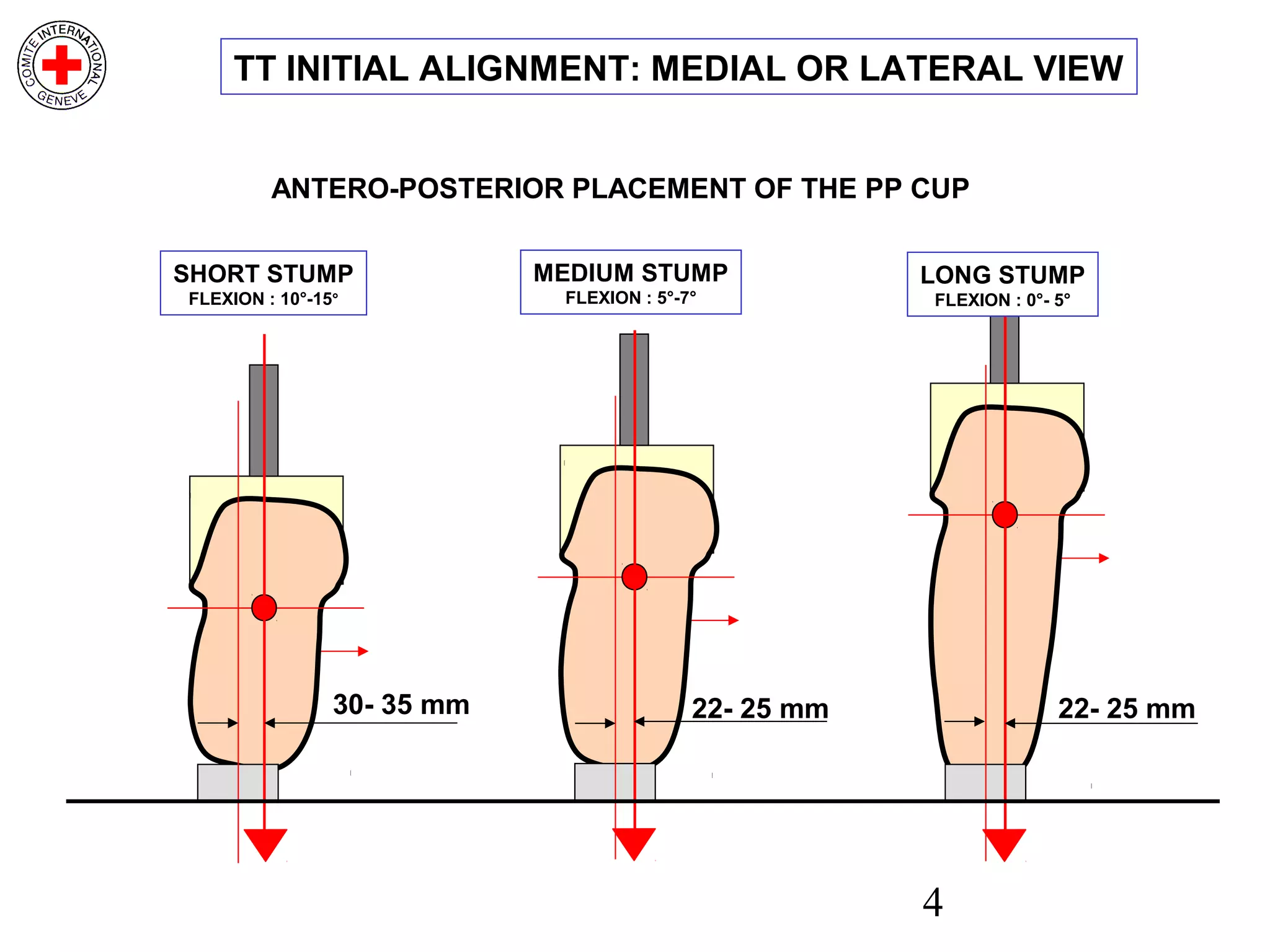 4
SHORT STUMP
FLEXION : 10°-15°
MEDIUM STUMP
FLEXION : 5°-7°
22- 25 mm30- 35 mm 22- 25 mm
ANTERO-POSTERIOR PLACEMENT OF THE PP CUP
TT INITIAL ALIGNMENT: MEDIAL OR LATERAL VIEW
LONG STUMP
FLEXION : 0°- 5°
 
