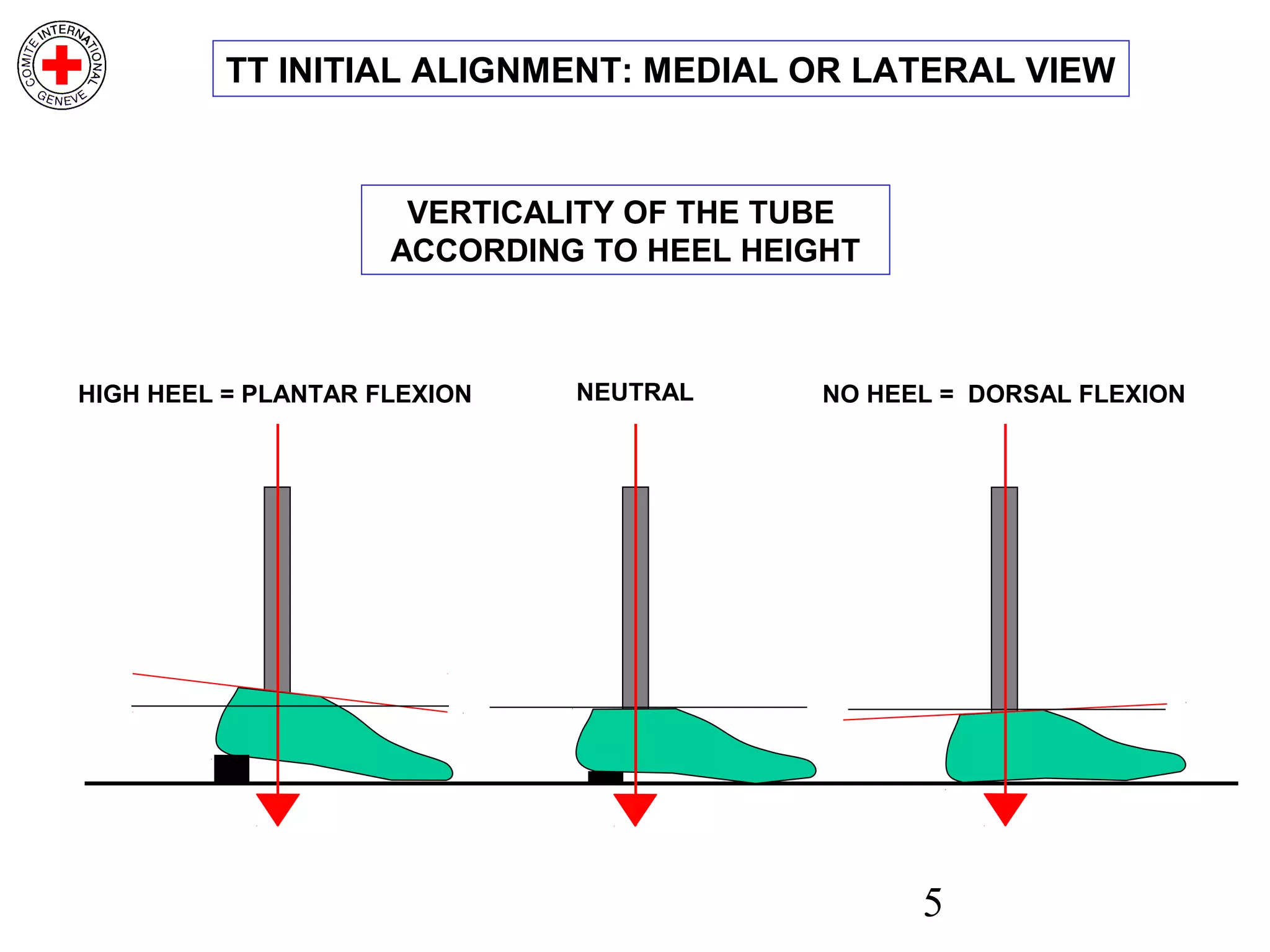 5
NEUTRAL
TT INITIAL ALIGNMENT: MEDIAL OR LATERAL VIEW
HIGH HEEL = PLANTAR FLEXION NO HEEL = DORSAL FLEXION
VERTICALITY OF THE TUBE
ACCORDING TO HEEL HEIGHT
 