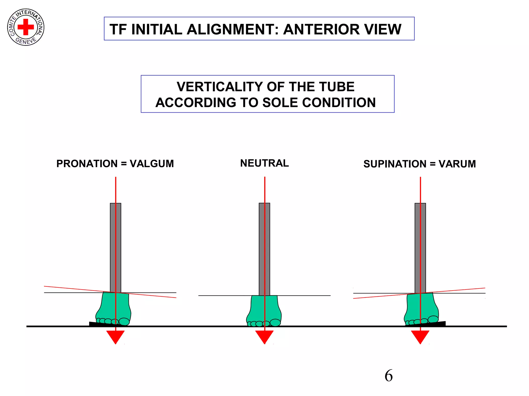 6
SUPINATION = VARUMPRONATION = VALGUM NEUTRAL
TF INITIAL ALIGNMENT: ANTERIOR VIEW
VERTICALITY OF THE TUBE
ACCORDING TO SOLE CONDITION
 