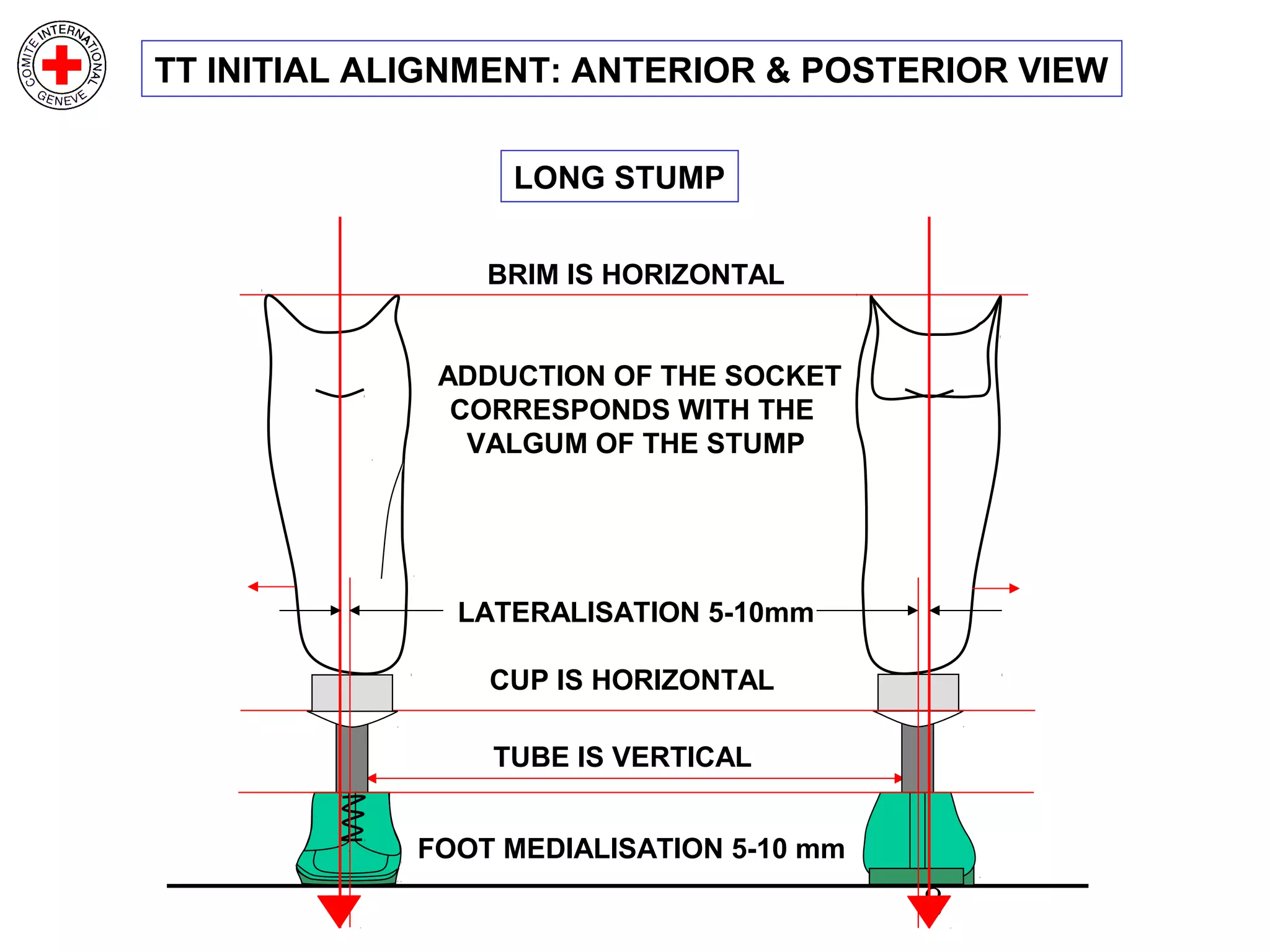 8
TUBE IS VERTICAL
FOOT MEDIALISATION 5-10 mm
BRIM IS HORIZONTAL
ADDUCTION OF THE SOCKET
CORRESPONDS WITH THE
VALGUM OF THE STUMP
LATERALISATION 5-10mm
CUP IS HORIZONTAL
LONG STUMP
TT INITIAL ALIGNMENT: ANTERIOR & POSTERIOR VIEW
 