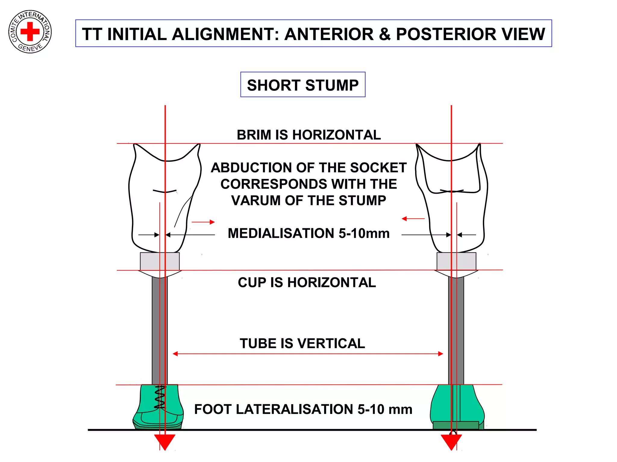 9
TUBE IS VERTICAL
FOOT LATERALISATION 5-10 mm
BRIM IS HORIZONTAL
ABDUCTION OF THE SOCKET
CORRESPONDS WITH THE
VARUM OF THE STUMP
MEDIALISATION 5-10mm
CUP IS HORIZONTAL
SHORT STUMP
TT INITIAL ALIGNMENT: ANTERIOR & POSTERIOR VIEW
 
