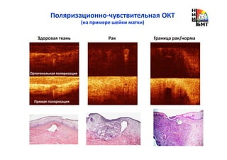 Поляризационно-чувствительная ОКТ
(на примере шейки матки)
Здоровая ткань Рак Граница рак/норма
Прямая поляризация
Ортогональная поляризация
 