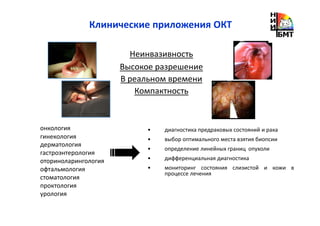 Клинические приложения ОКТ
онкология
гинекология
дерматология
гастроэнтерология
оториноларингология
офтальмология
стоматология
проктология
урология
• диагностика предраковых состояний и рака
• выбор оптимального места взятия биопсии
• определение линейных границ опухоли
• дифференциальная диагностика
• мониторинг состояния слизистой и кожи в
процессе лечения
Неинвазивность
Высокое разрешение
В реальном времени
Компактность
 