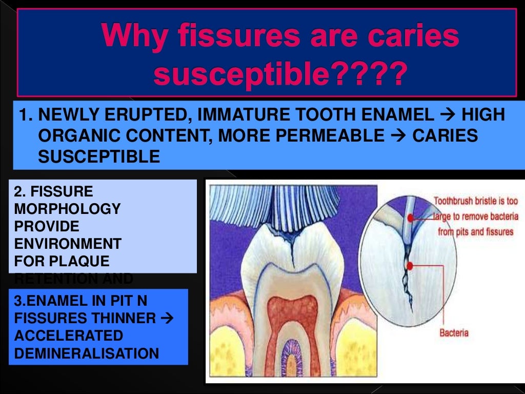 Pit and fissure sealants