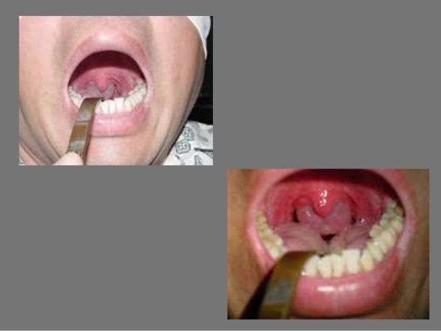 obstructive nasal polyps