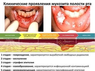 Клинические проявления мукозита полости рта
1 стадия – повреждение, характеризуется выработкой свободных радикалов
2 стадия – воспаление
3 стадия – атрофия эпителия
4 стадия – язвообразование, характеризуется инфекционной контаминацией
5 стадия – реконвалесценция, характеризуется пролиферацией эпителия
 