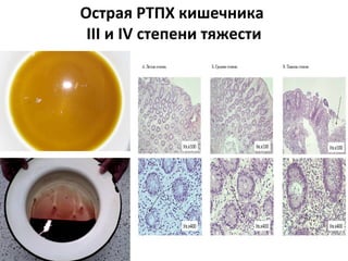 Острая РТПХ кишечника
III и IV степени тяжести
 