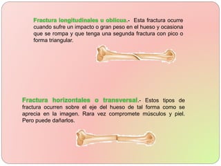 .- Esta fractura ocurre
cuando sufre un impacto o gran peso en el hueso y ocasiona
que se rompa y que tenga una segunda fractura con pico o
forma triangular.
.- Estos tipos de
fractura ocurren sobre el eje del hueso de tal forma como se
aprecia en la imagen. Rara vez compromete músculos y piel.
Pero puede dañarlos.
 