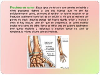 .- Estos tipos de fractura son usuales en bebés o
niños pequeños debido a que sus huesos aun no son los
suficientemente duros, entonces si reciben un fuerte impacto no se
fracturan totalmente como los de un adulto, si no que se fractura por
partes es decir, algunas partes del hueso queda unido o intacto y
otras si hay ruptura pero sin que se desprenda, es como cuando
doblas una rama de árbol tierna es difícil que se quiebre totalmente,
solo queda doblada y lesionada la sección donde se trató de
romperla, lo mismo ocurre con los infantes.
 