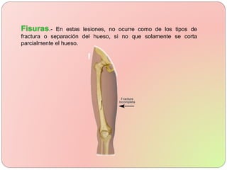 .- En estas lesiones, no ocurre como de los tipos de
fractura o separación del hueso, si no que solamente se corta
parcialmente el hueso.
 