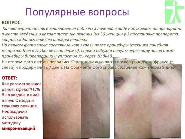 Сферогель применение в косметологии. Разбор вопросов