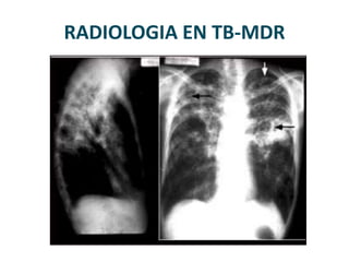 RADIOLOGIA EN TB-MDR
 