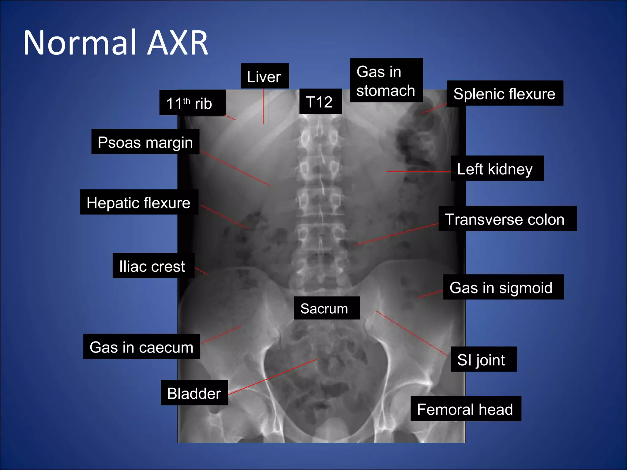 Abdominal X ray | PPT