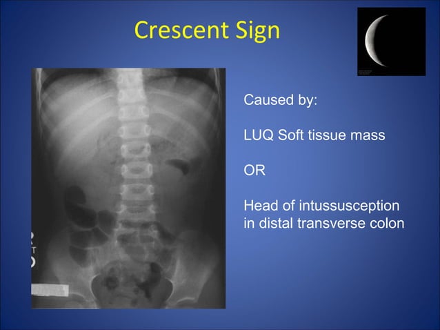 Abdomen xray signs | PPT