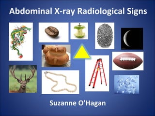 Abdominal X-ray Radiological Signs
Suzanne O’Hagan
 