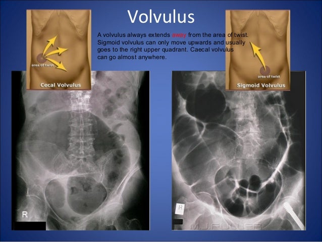 Abdomen xray signs
Volvulus X Ray Omega Sign