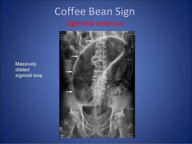 Abdomen xray signs