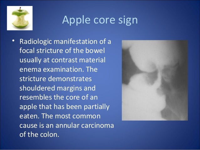 Learning Radiology Colon Carcinoma