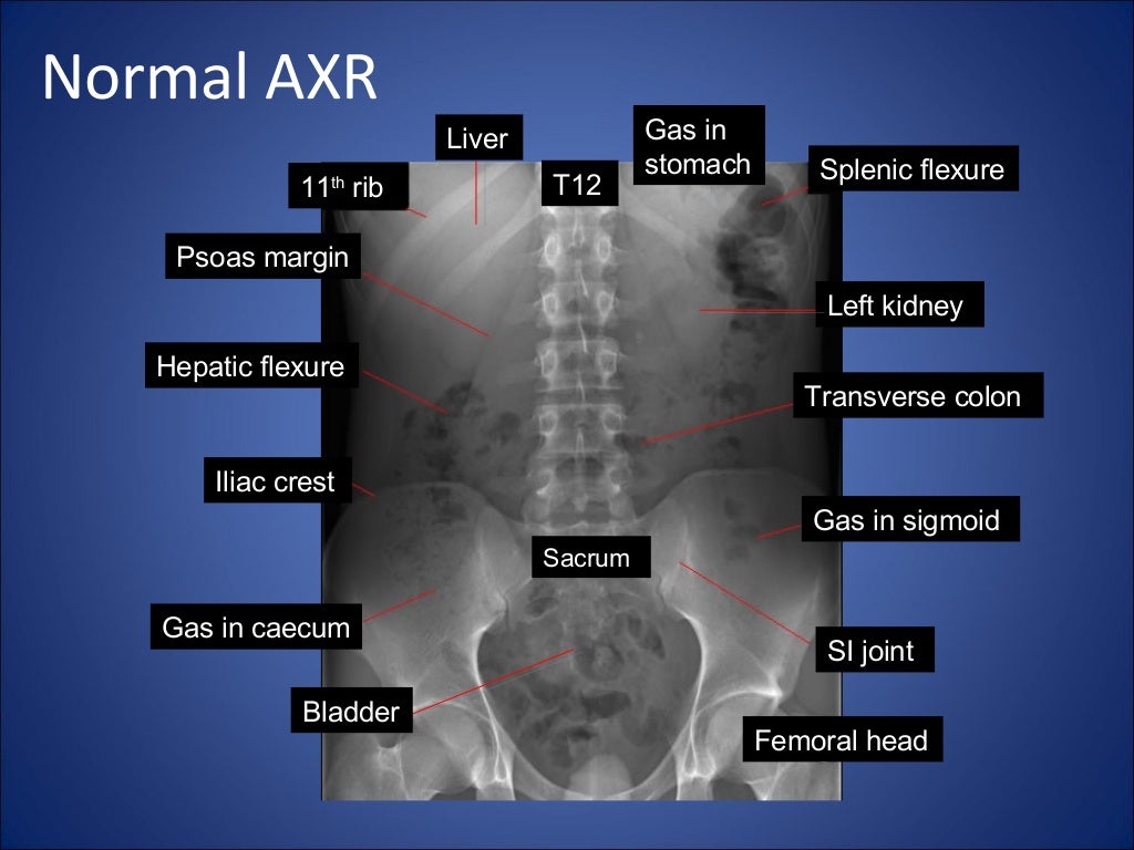 Abdomen xray signs