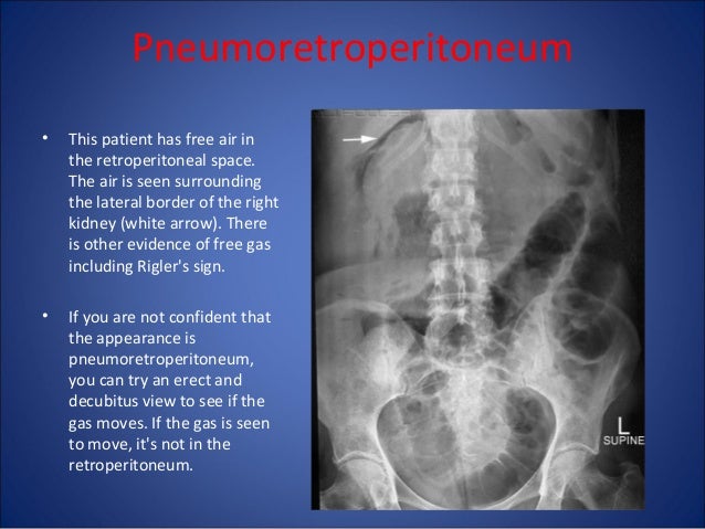 Abdomen Xray Signs