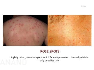 Slightly raised, rose-red spots, which fade on pressure. It is usually visible
only on white skin
 