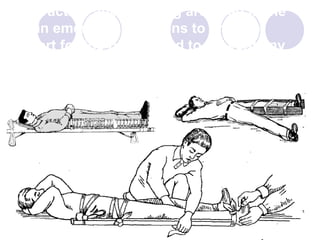 Transport Splint Fracture of Femur | PPT
