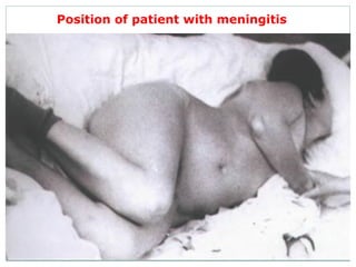 Position of patient with meningitis
 