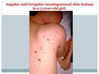 Angular and irregular meningococcal skin lesions
in a 5-year-old girl.
 