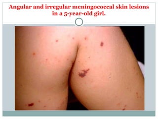 Angular and irregular meningococcal skin lesions
in a 5-year-old girl.
 