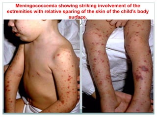Meningococcemia showing striking involvement of the
extremities with relative sparing of the skin of the child’s body
surface.
 